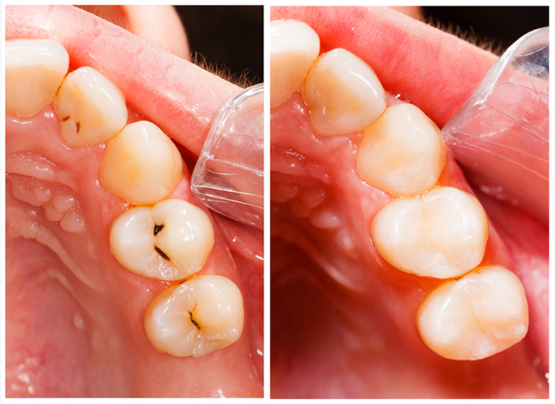 Fillings Nanoose Bay, BC VP J