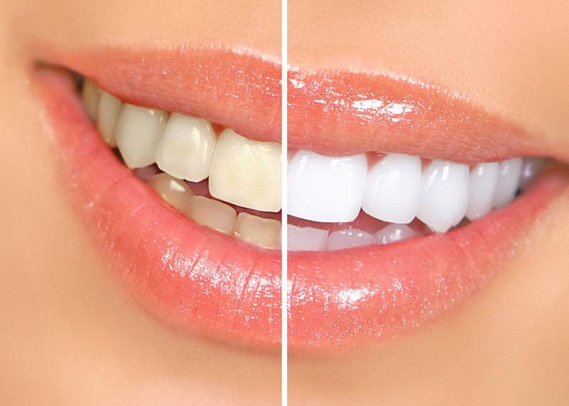 Teeth Whitening Nanoose Bay, BC VP J